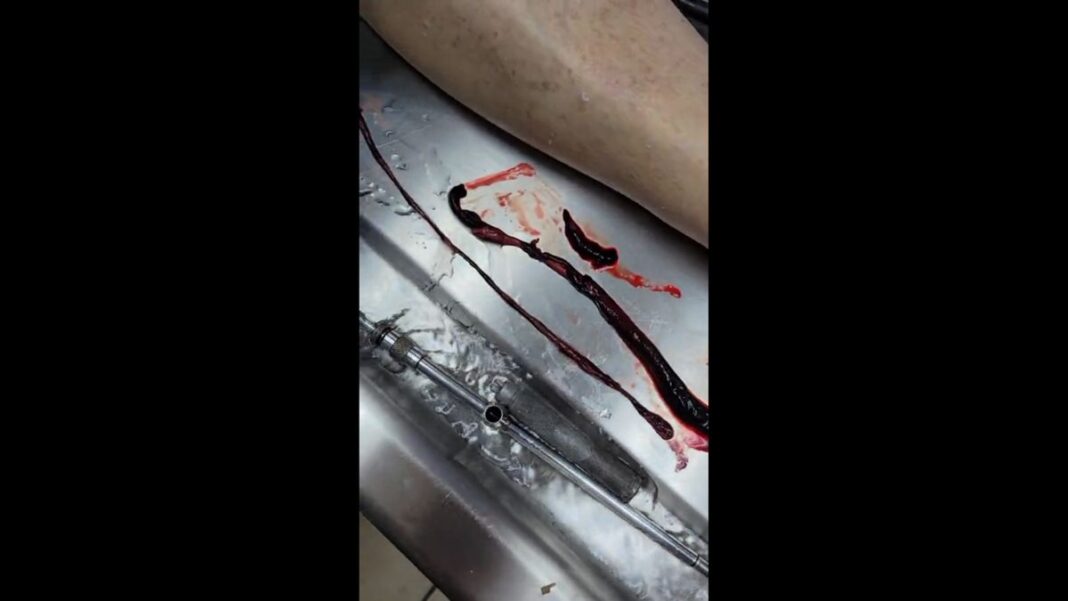 Unbelievable blood clots: video from embalmer Richard Hirschman