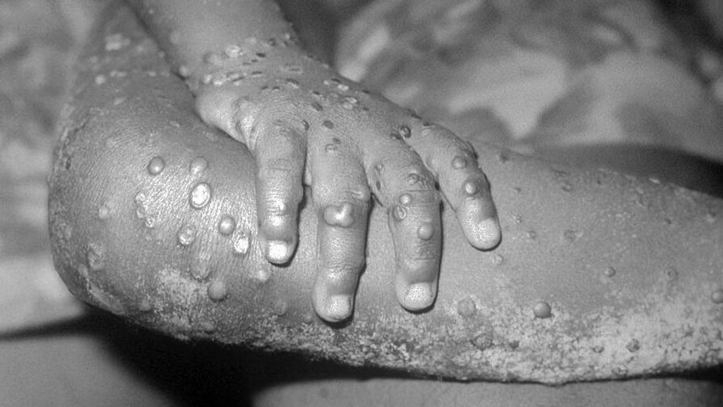 A 1971 photo from the CDC shows monkeypox-like lesions