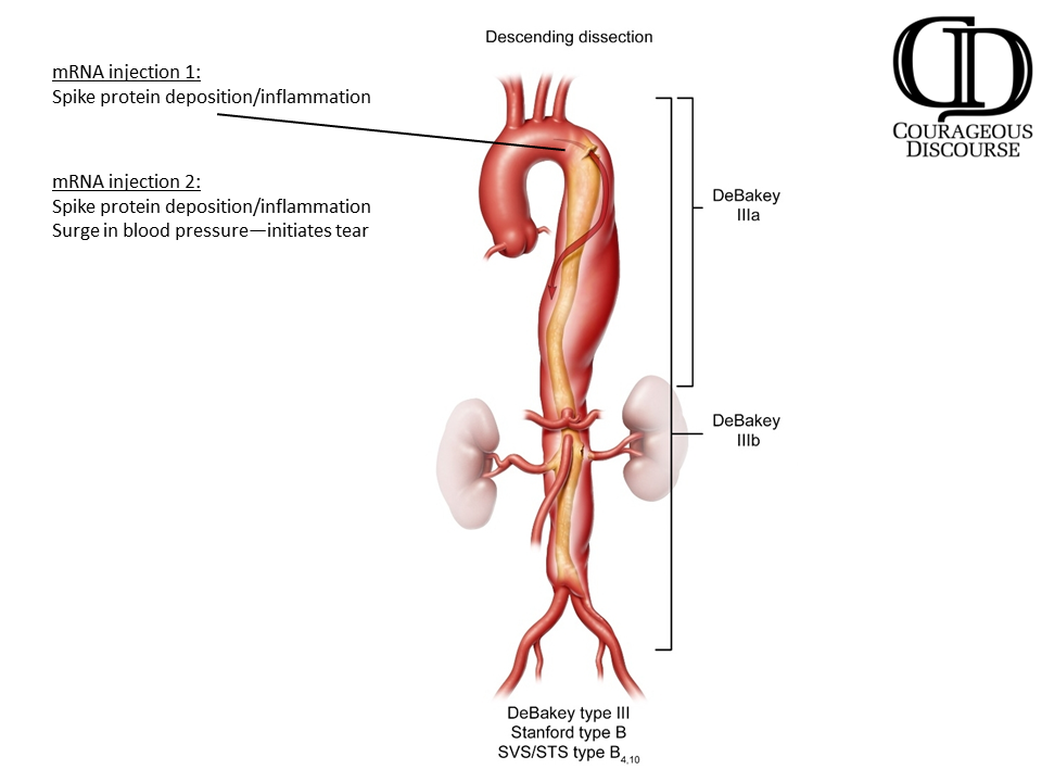 Descending Dissection