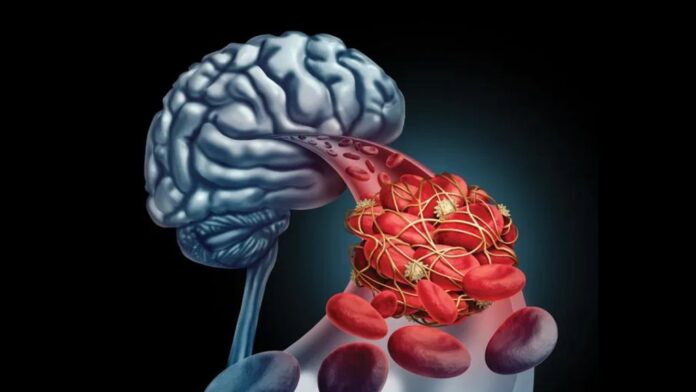 Stroke Clot Image Stroke Clot Image