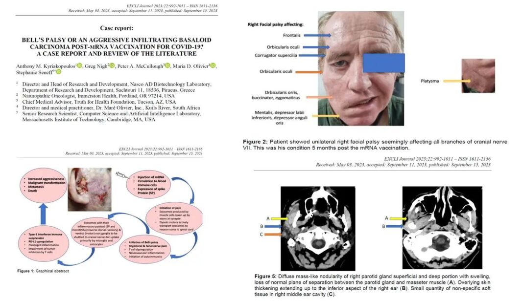 Bell’s palsy or an aggressive infiltrating basaloid carcinoma post-mRNA vaccination for COVID-19?