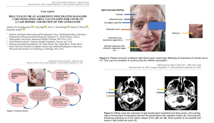 Bell’s palsy or an aggressive infiltrating basaloid carcinoma post-mRNA vaccination for COVID-19? Bell’s palsy or an aggressive infiltrating basaloid carcinoma post-mRNA vaccination for COVID-19?