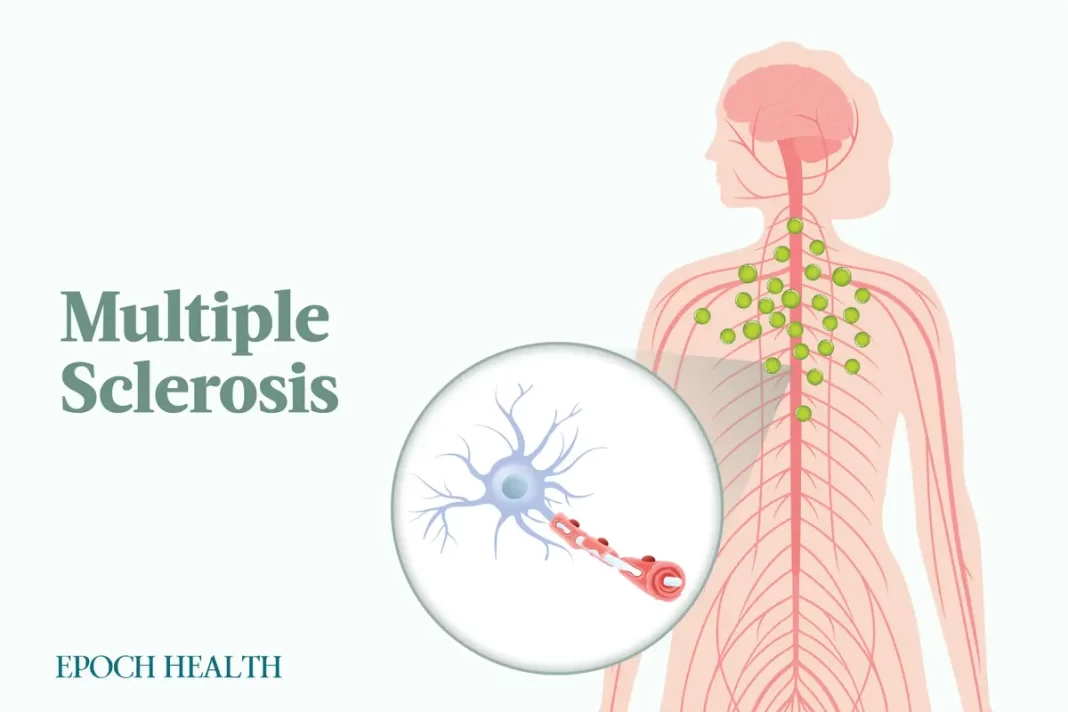 Multiple Sclerosis typically manifests between the ages of 20 and 40