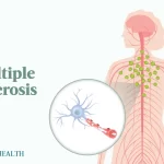 Multiple Sclerosis typically manifests between the ages of 20 and 40