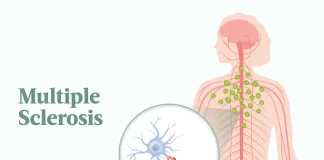 Multiple Sclerosis typically manifests between the ages of 20 and 40