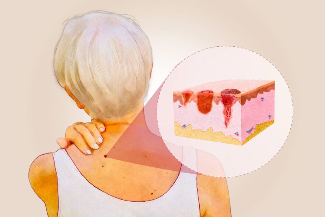 Protecting your skin and knowing the warning signs may help reduce your risk of skin cancer.