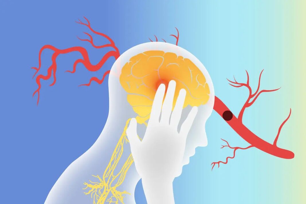 Stimulating the Vagus Nerve May Help With Stroke Recovery–Here’s How
