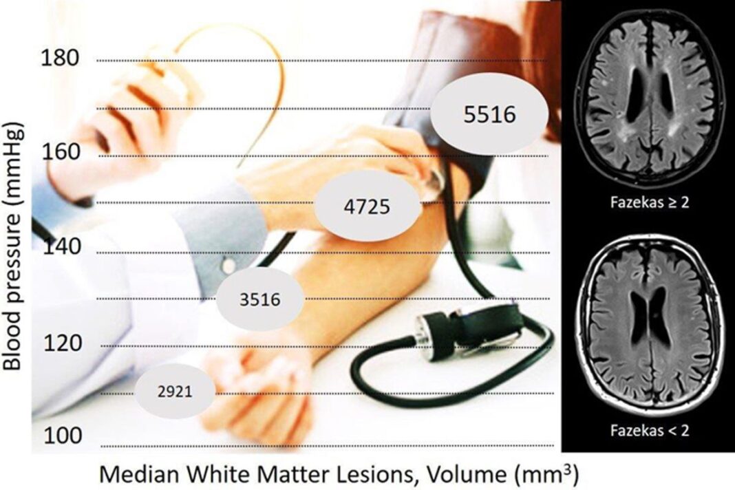 Blood Pressure and Brain Lesions in Patients With Atrial Fibrillation